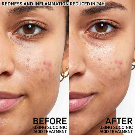 THE INKEY LIST Succinic Acid Blemish Treatment (15ml)