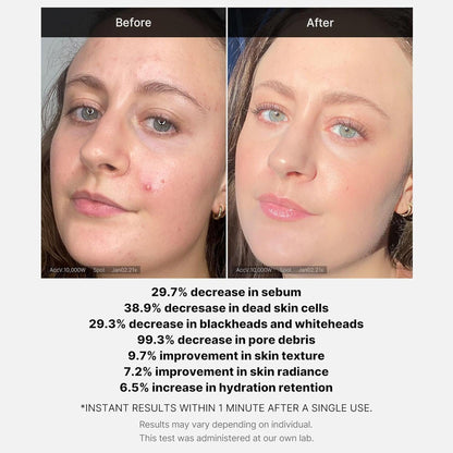 Medicube - Red Acne Succinic Acid Peel 40g